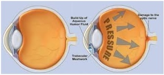glaucoma specialist in jalandhar